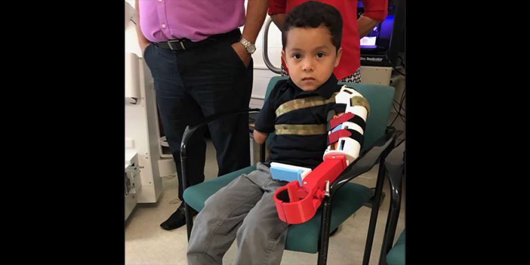 3D-Printed Prosthetic Arm for Youngest Patient Yet