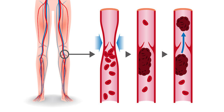 New Prevention Measures Reduce Complications Following Surgery